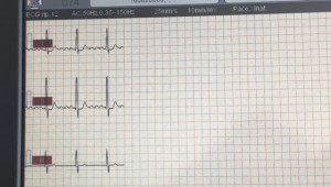 Derivazioni bipolari d1-d2-d3 dell'ecg registrate con biocare ie6