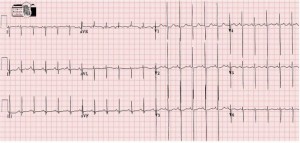 ecg neonatale 1 giorno di vita