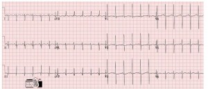 ecg neonatale 2 giorni di vita