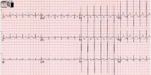 ecg neonatale 8 mesi di vita