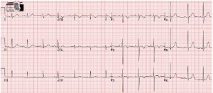 ecg pediatrico 6 anni di vita