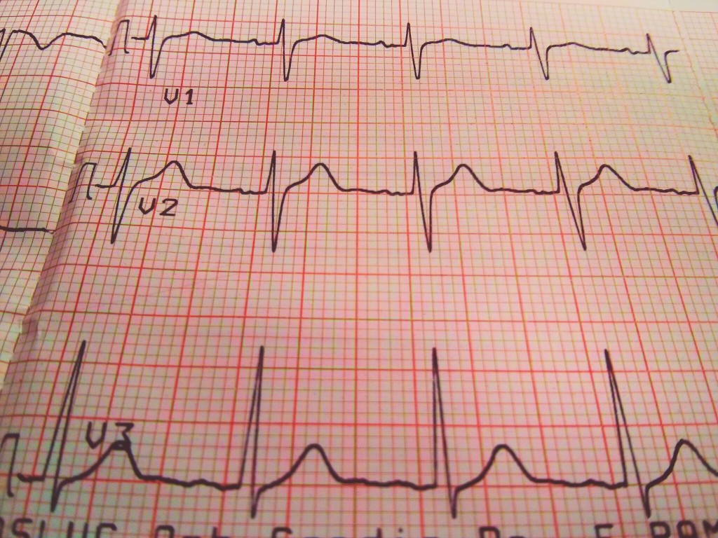 tracciato ecg