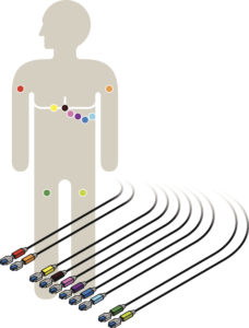 posizionamento degli elettrodi nell'elettrocardiografo a 12 derivazioni e 10 fili